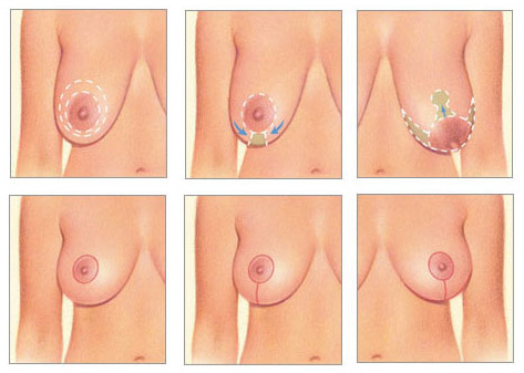 image-of-breast-lift-technique-phases