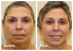 facelift plastic surgery