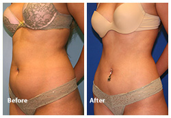 liposuction surgery