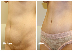 tummy tuck surgery